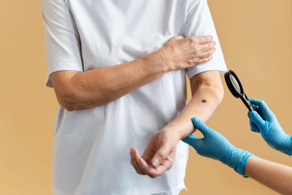 Understanding Melanoma Why Blanching Matters And When It Doesn T - 723nkha